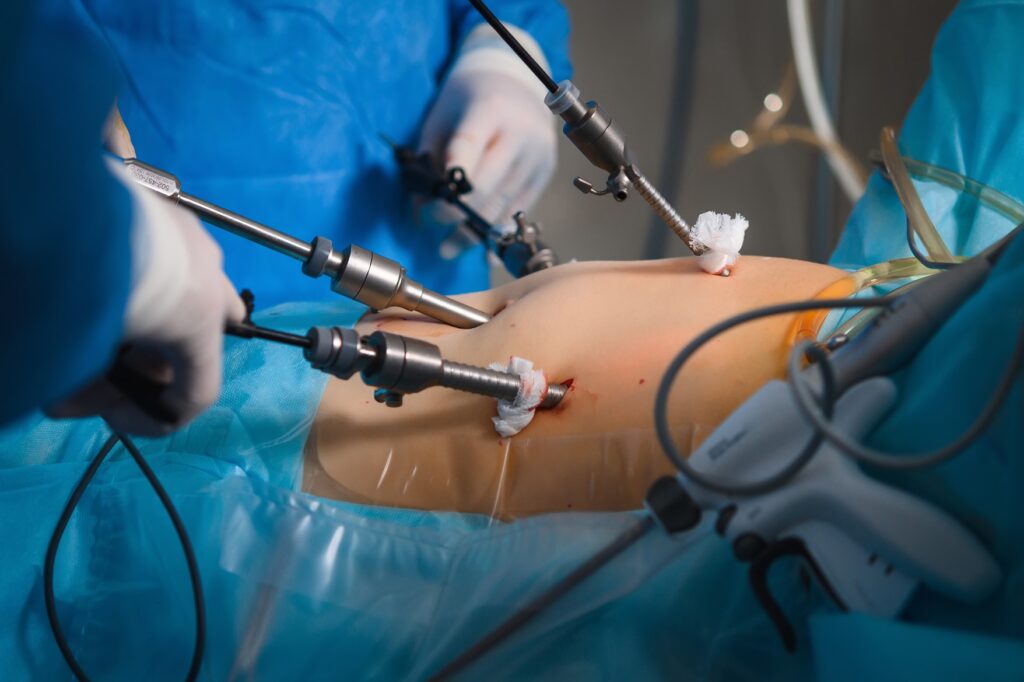 What Is a Laparoscopic Hysterectomy?